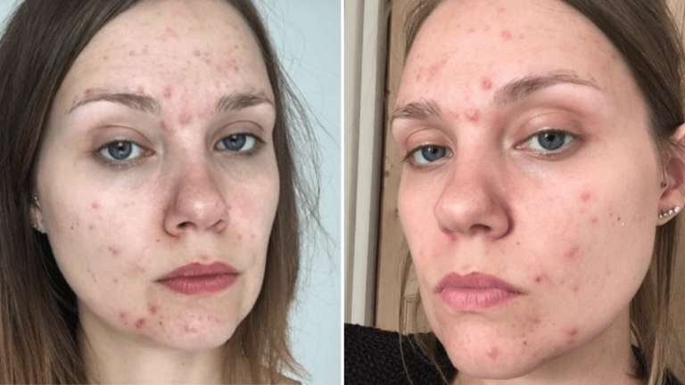 Acne Awareness Month – Our Founder’s Acne Journey